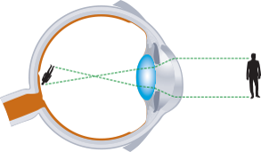 Astigmatism